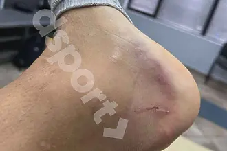 Защитник на Берое със сериозен оток след “инцидентното настъпване” на Сангаре 