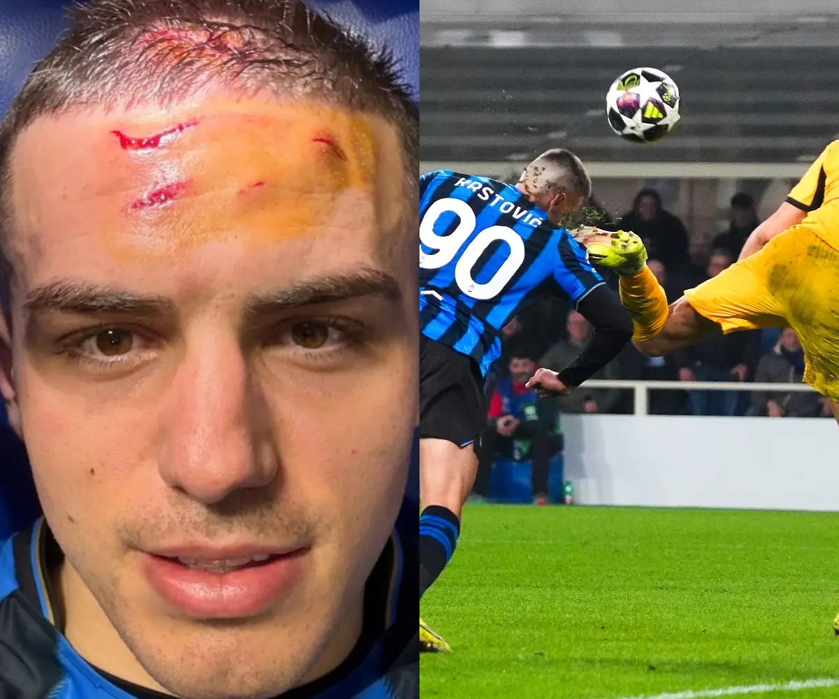 Как изглежда нападателят на Аталанта след тежкия удар в главата?