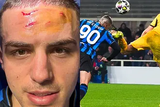 Как изглежда нападателят на Аталанта след тежкия удар в главата? 